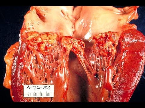 ემერჯენსი / ენდოკარდიტის ნიშნები / ინფექციური ენდოკარდიტი / ბაქტერიული ენდოკარდიტი / ენდოკარდიტი