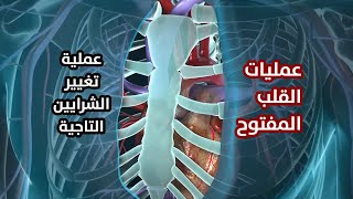 عملية القلب المفتوح - تغيير الشرايين التاجية CABG