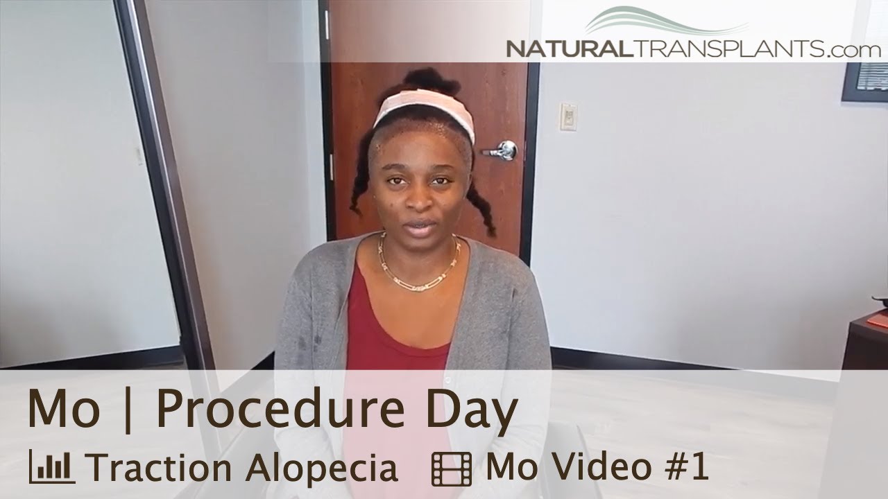 fue hair transplant month by month African American Hair Loss Around Edges | Restore Edges African American Hair (Mo)