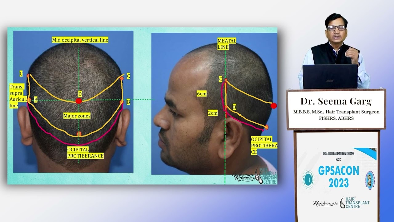 CONCEPT OF SAFE DONOR AREA Dr. Seema Garg