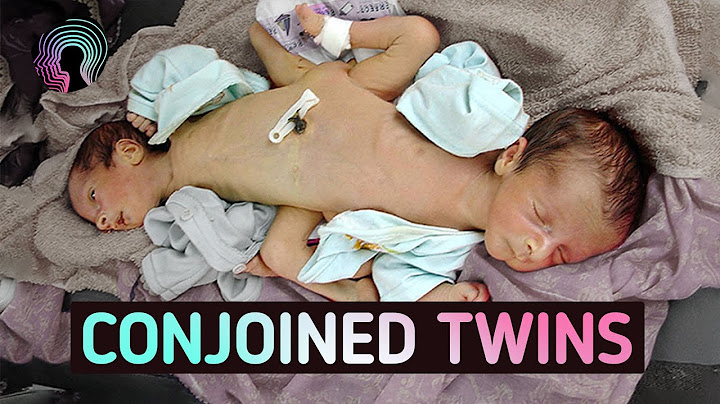 Conjoined Twins