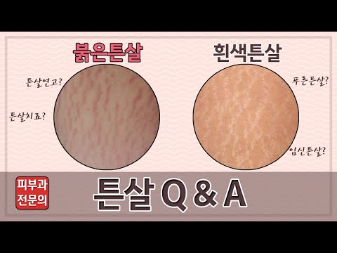 피부과 전문의가 알려주는 튼살에 대한 궁금증(튼살Q&A)