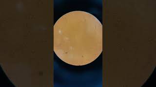 Semen Analysis Under Microscope | Sperm Motility Dead |