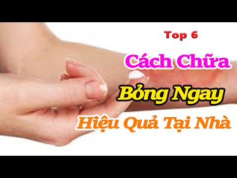 Top 6 Cách chữa vết bỏng an toàn và hiệu quả