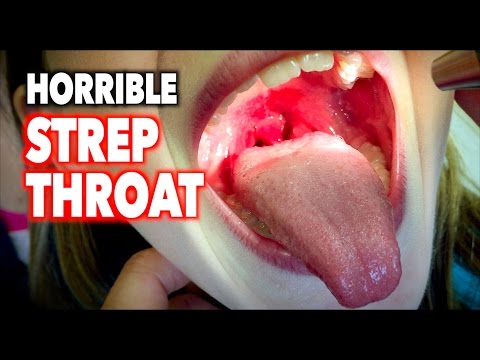 Strep throat wiki