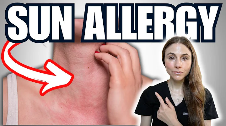 Sun Allergy or Something Worse? Know the Signs