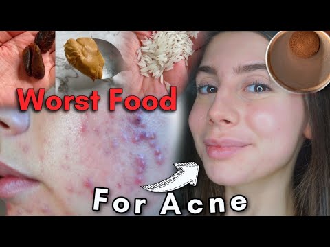 What foods to NOT eat for ACNE! If you struggle with acne like me watch this..