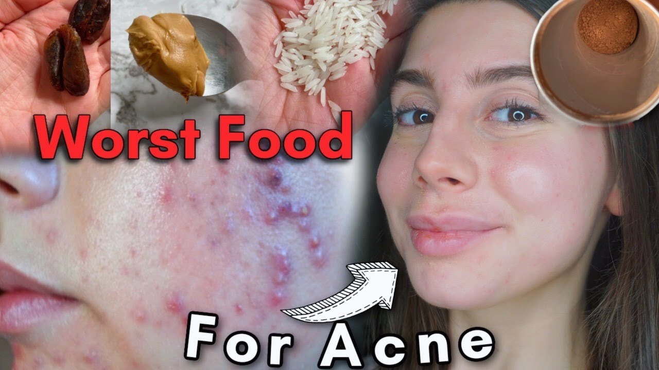What foods to NOT eat for ACNE! If you struggle with acne like me watch this.. YouTube