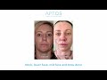 Aptos Thread Lift Visage Excellent Method