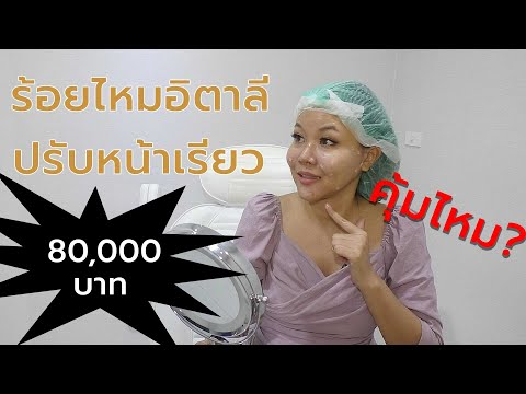 (เช็คสูตร) ร้อยไหมอิตาลี ยกกระชับ ปรับรูปหน้า 80,000 บาท ที่อะกาลิโกคลินิก I กูรูยาหม่อง