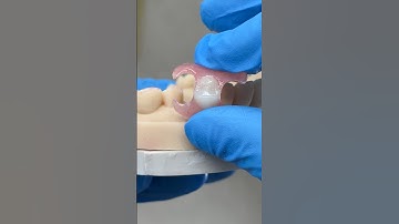 Premolar Flipper Partial @EnvisiontecMain #envisiontec #lsk121shorts #dental #teeth