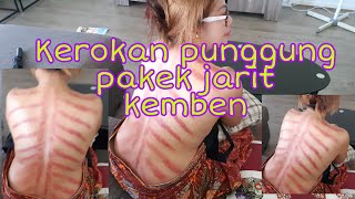 Kerokan  Punggung Masuk Angin Kasep Menggunakan Jarit Indonesia @YuliJapung