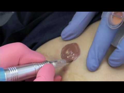 Breast Tattooing Cancer Patient by Dr Linda Dixon MD