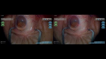 3D Surgery: Basics of Phacoemulsification: Hydrodissection (Part 3/6)