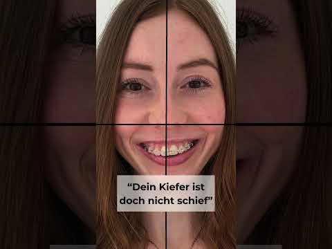 Jaw Surgery is the only way to advance the Maxilla... or is it? 🤔 #maxilla #jawsurgery #facemask