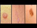 Skin Tag Vs Warts On Face