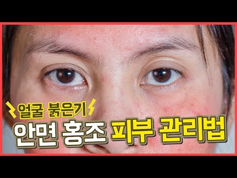 <strong>얼굴</strong> 붉은기 안면 <strong>홍조</strong> 피부를 관리하는 방법