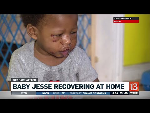 1-year-old recovering after day care attack