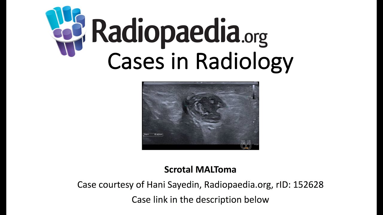 Scrotal MALToma (Radiopaedia.org) Cases in Radiology