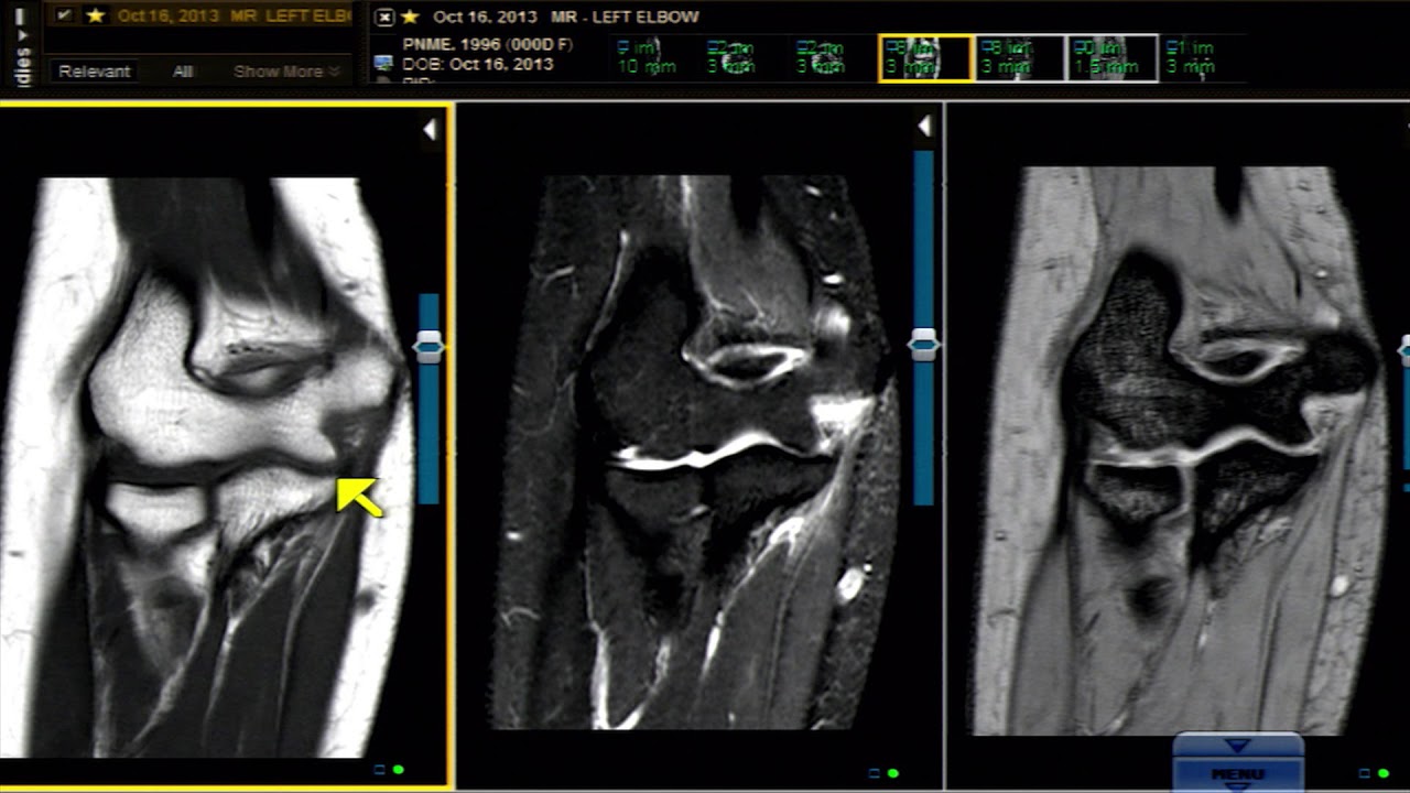 Case Review: 17-Year-Old Female Patient with Pulling Injury on MRI ...