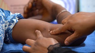 Removing Contraceptive Implants (Health Workers) - Family Planning Series