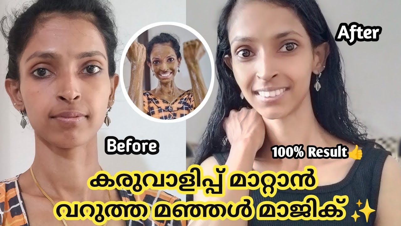 ✨മുഖത്തെയും ശരീരത്തെയും കരിവാളിപ്പ് മാറ്റാൻ വറുത്ത മഞ്ഞൾ ഇങ്ങനെ ഉപയോഗിക്കൂ!💯👍| #anussimplybeauty