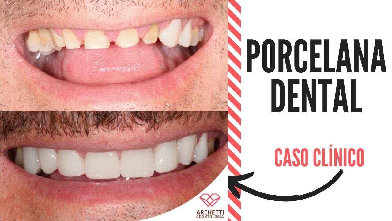 Dentes em Porcelana + Bruxismo - Antes e Depois - Caso clínico completo ...