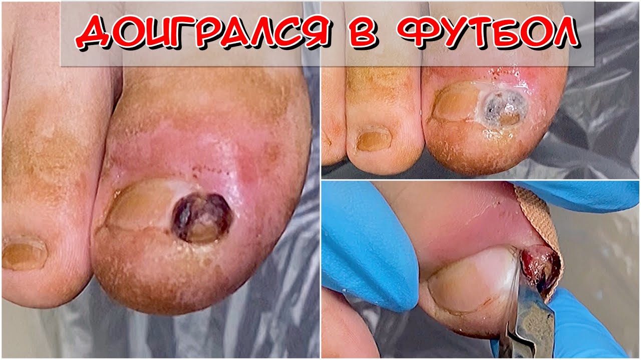 Доигрался в футбол / Затянул с визитом к подологу / Гранулема / Грануляция / Врос / Вросший ноготь