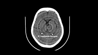 Ring artifacts - CT scan