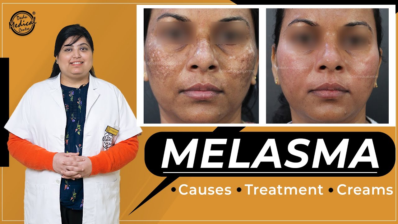 How to treat MELASMA Treat DARK SPOTS & PATCHES on the skin Causes & Best Creams of Melasma