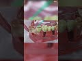 Waldent NanoFill Zirconium Composite Kit - Superior Dental Restorative Material