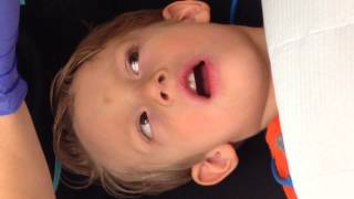 Demonstration of Fluoride Varnish Application