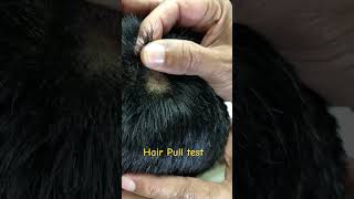 A Positive Hair Pull Test