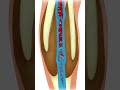 Three Warning Signs Of High Cholesterol | Do not Ignore Them