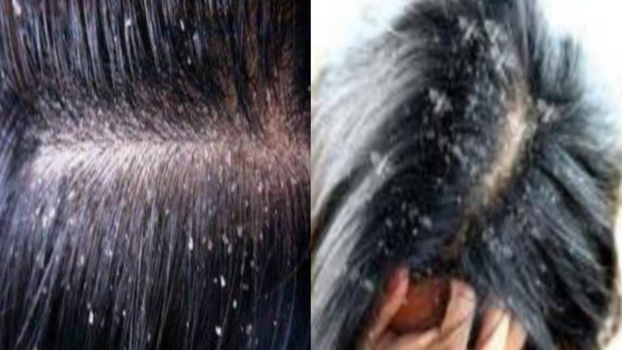 علاج  القشره  المزمنه من الشعر وافضل علاج للتخلص نهائي من القشره