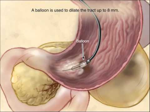 Video: Pancreatic Necrosis Of The Pancreas - Surgery, Treatment