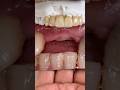 Layered Zirconia Bridge that we completed in my lab for Dr. John Rothchild in Colorado