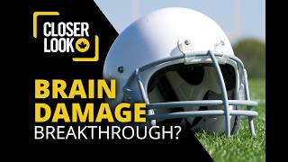 The Brain Disease That Can Only Be Diagnosed After Death Until Now