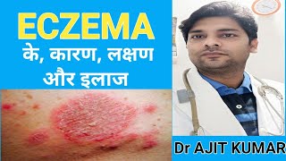 Eczema का इलाज। Eczema Treatment In Ayurveda, Eczema Treatment In Hindi,