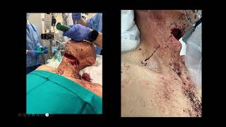 Penetrating Neck Trauma: Diagnostic and Therapeutic Challenges
