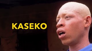 Man With Albinism Makes A New Friend Kaseko