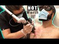 My LAST Laser Tattoo Removal Session Using the PicoSure