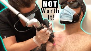 My LAST Laser Tattoo Removal Session Using the PicoSure