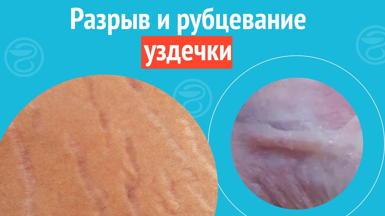Что делать, если порвал уздечку во время секса Что делать, если порвал уздечку во время секса