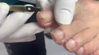 Sharp nail treatment by BABI TOYS 3 views 3 years ago 1 minute, 45 seconds