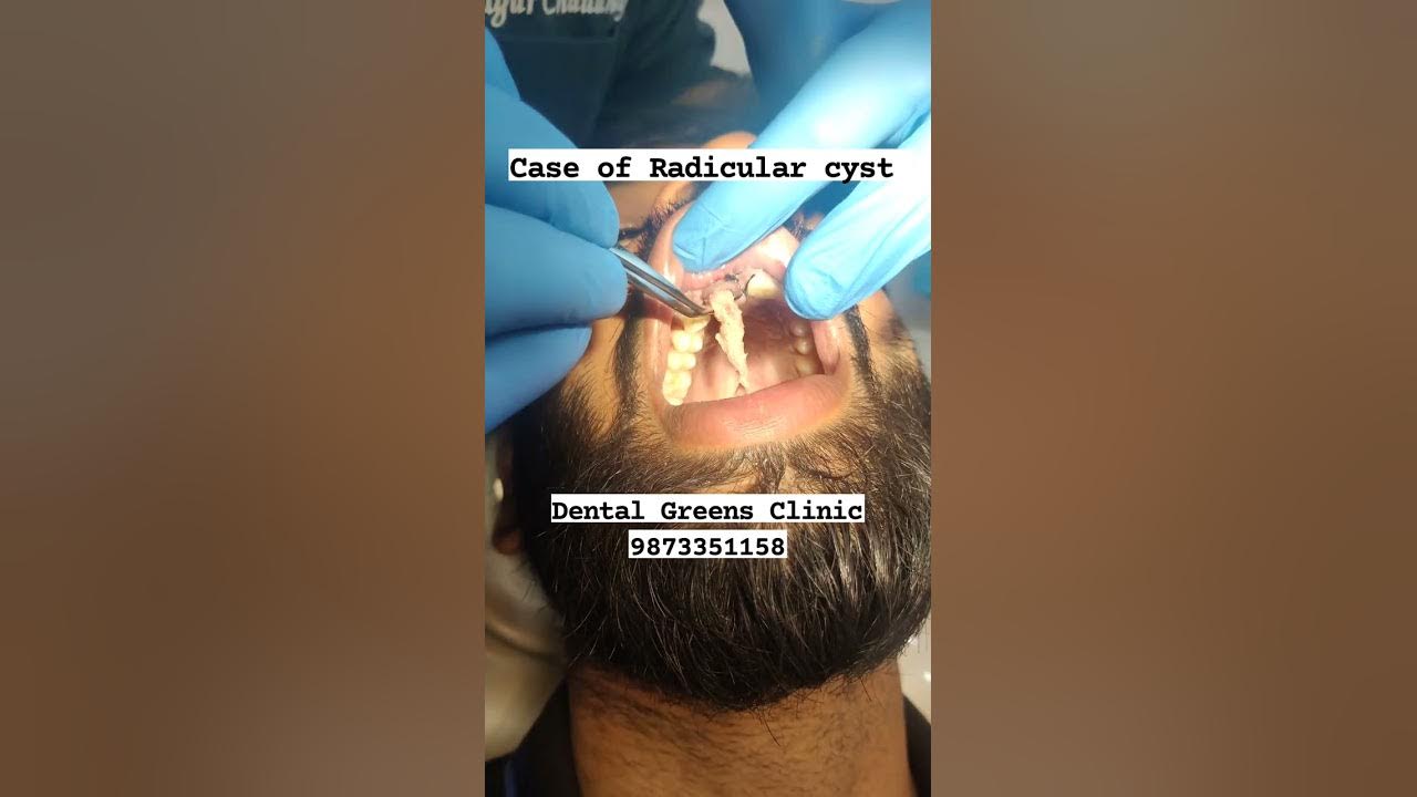 a-case-of-radicular-cyst-rct-followed-by-enucleation-of-the-cyst