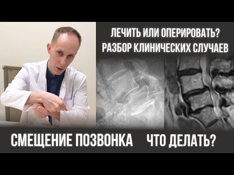 спондилолистез пояснично крестцового отдела позвоночника лечение или операция