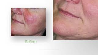 Skin Renewal with Icon™