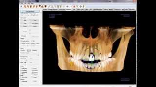 3D Restoration Planning with the Invivo5 Software