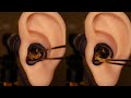 【ASMR】ピンセットのみ‼️ベリッと剥がす耳垢除🤩Remove earwax using only tweezers✨족집게만을 사용하여 귀지를 딱딱하게 벗겨냅니다.💖おすすめ／ティングル